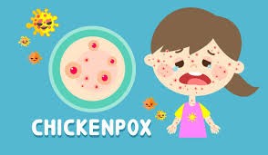 Chicken Pox:Simple and Clear Guide to Symptoms, Care, and Recovery Chicken Pox:Simple and Clear Guide to Symptoms, Care, and Recovery
